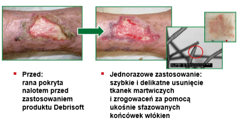 oczyszczanie rany