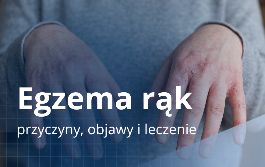 Egzema rąk: przyczyny, objawy i leczenie